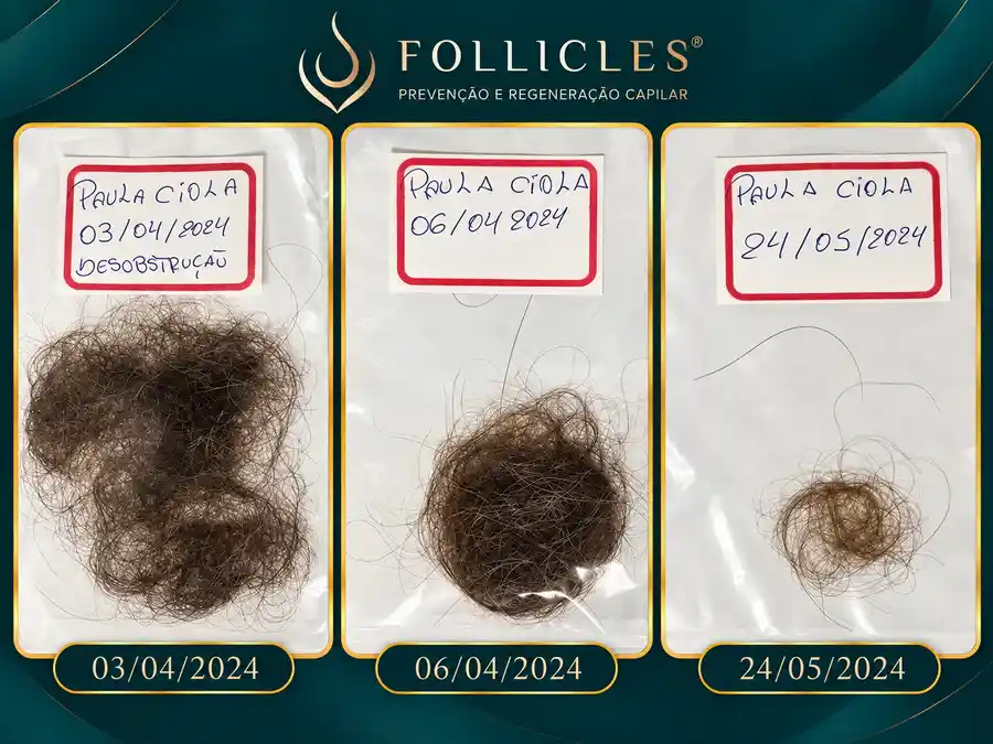 Resultado de queda capilar — paciente da Clínica Follicles, imagem 1